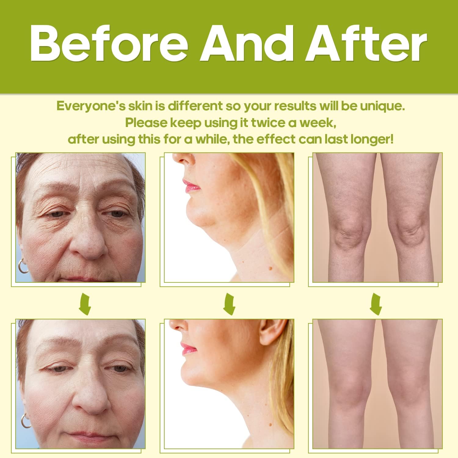 Appareil RF Radiofréquence TUMAKOU – Anti-Rides, Raffermissement, Régénération du Collagène